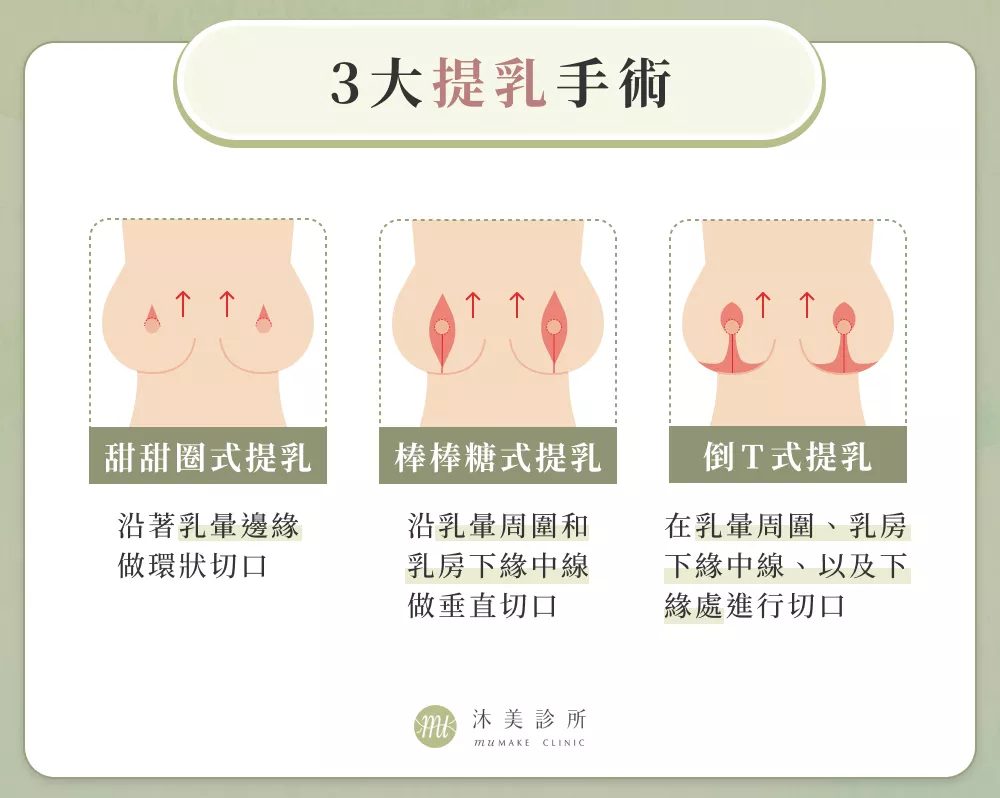 3大提乳手術